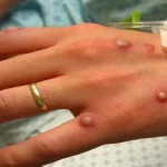 Monkeypox-Virus-Symptoms